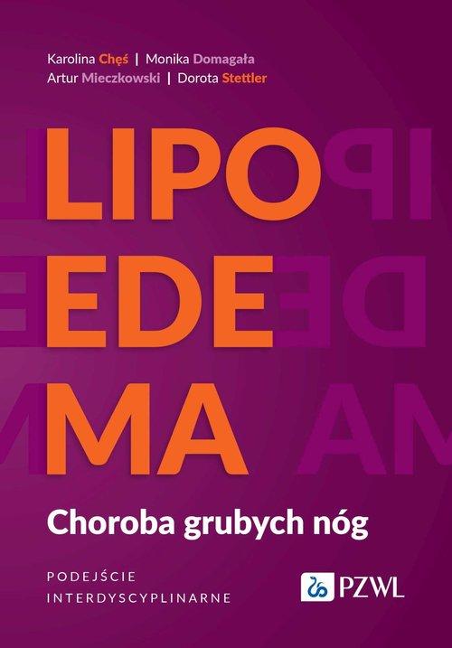 Lipoedema – Kompleksowe podejście do obrzęków tłuszczowych