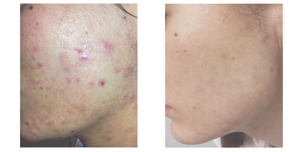 Kolagen na trądzik Larens Peptidum Face Gel Efekty Stosowania