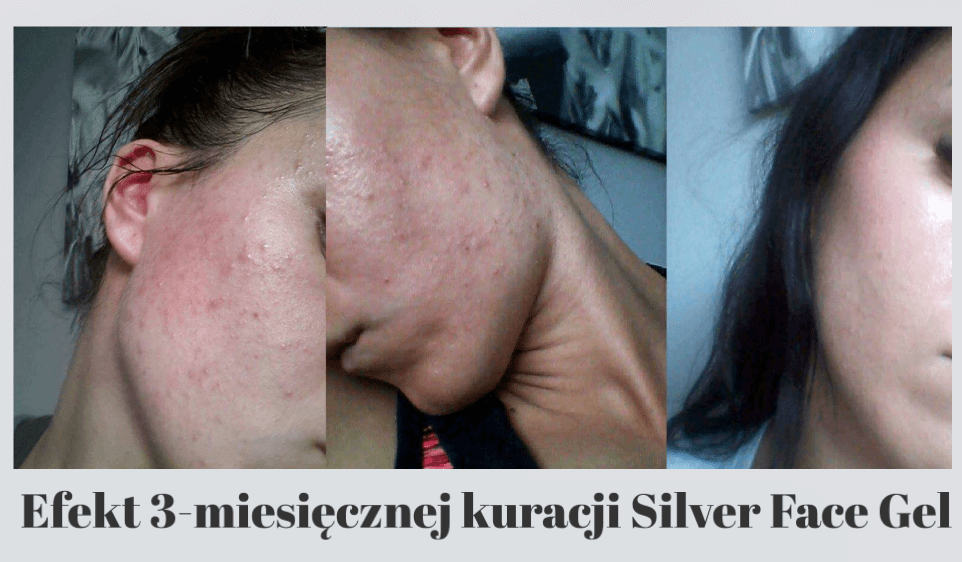 Silver Face Żel na trądzik