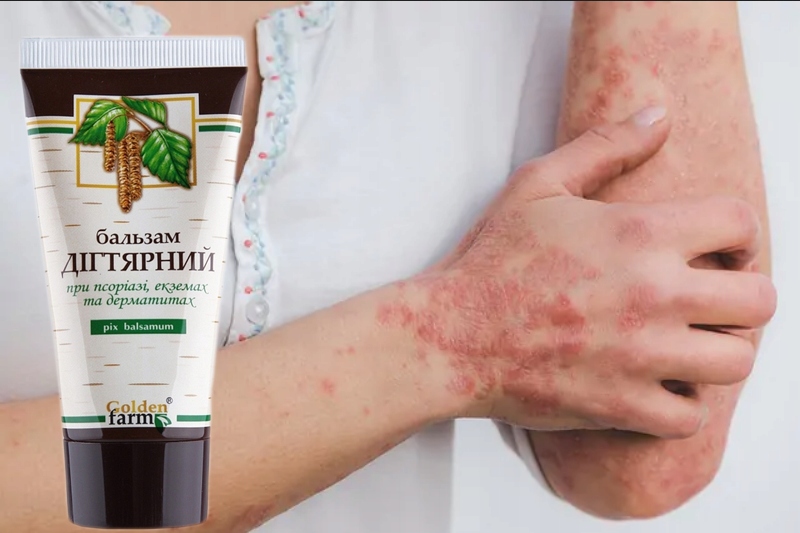 Właściwości terapeutyczne balsamu dziegciowego