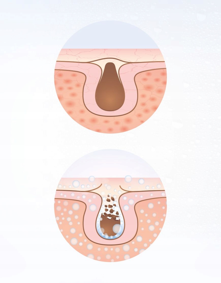 Głębokie oczyszczanie twarzy z zanieczyszczeń