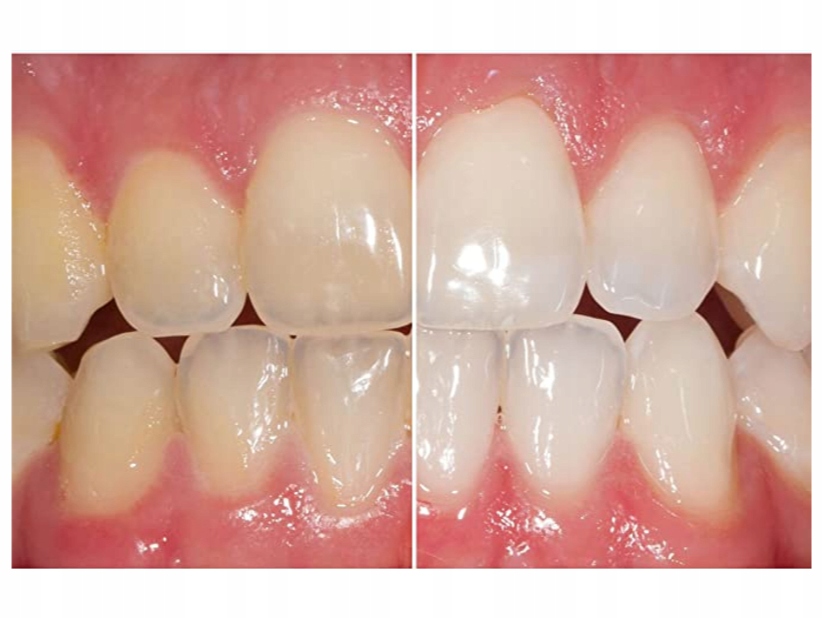 Łagodzenie przebarwień po kawie, herbacie i tytoniu