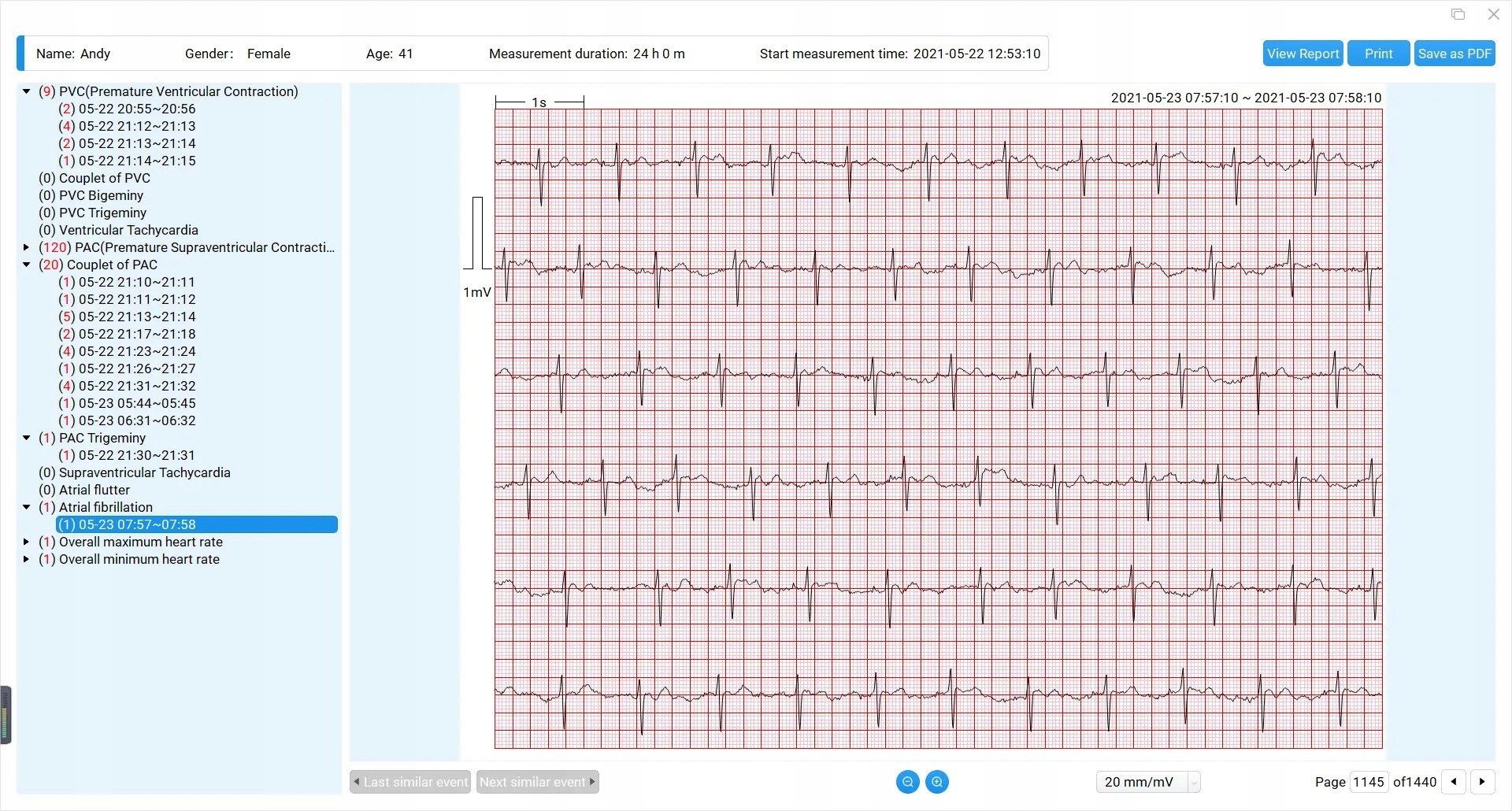 Innowacyjna analiza EKG z wykorzystaniem sztucznej inteligencji