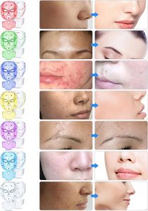 inSPORTline Pielęgnacyjna maska LED na twarz i szyję terapia fotonowa inSPORTline Hilmana 15