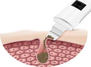 Beauty Limited Peeling kawitacyjny 5w1 WODOODPORNY 8