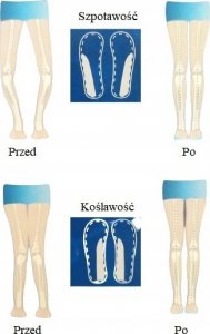 TYNOR Wkładki Ortopedyczne Koślawość Szpotawość 2 Sztuki 3