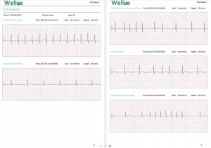 Ciśnieniomierz Wellue 72-godzinny Holter EKG z ekranem Analiza Aplikacja na PC i telefon ER1-LW 6