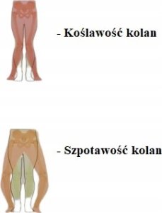 TYNOR Orteza na Szpotawość i Koślawość Stabilizator Stawu Kolanowego - L; A 7