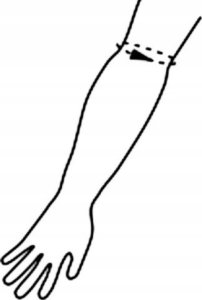 ORTHO VISIONS Orteza Łokcia Stabilizator Stawu Łokciowego Opaska 5