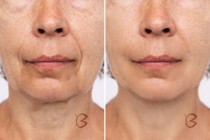 Beautifly Beautifly B-Glossy blush beadatinė mezoterapija 6