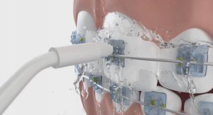 Końcówka Seysso Carbon Orthodontic 2szt. 3