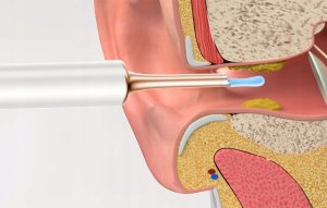 Bebird Otoskop z kamerą do czyszczenia uszu Bebird Note 5 pro (niebieski) 12