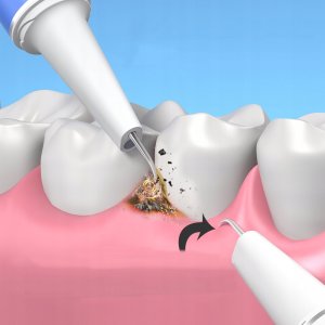 ULTRADŹWIĘKOWY SKALER DENTYSTYCZNY DO CZYSZCZENIA ZĘBÓW WiFi KAMERA LED 5MP 3