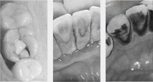 ULTRADŹWIĘKOWY SKALER DENTYSTYCZNY DO CZYSZCZENIA ZĘBÓW WiFi KAMERA LED 5MP 8