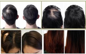 Laserowy Grzebień na Porost Włosów - Przeciw Wypadaniu, Masaż Laser RF EMS 6