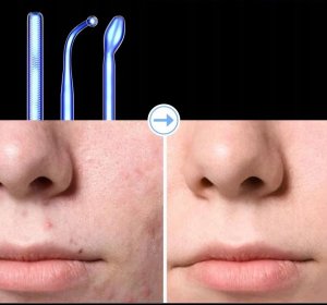 Najmocniejszy Darsonval 7 Pelot - Profesjonalne Urządzenie Kosmetyczne 12