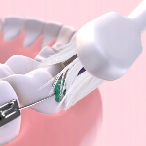 GUM KOŃCÓWKI DO SONICZNEJ SONIC ORTHO 4