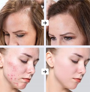 PROFESJONALNY DARSONVAL URZĄDZENIE KOSMETYCZNE DO TWARZY I SKÓRY + 5 PELOT 4