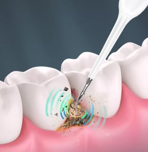 SZCZOTECZKA SONICZNA SKALER USUWA KAMIEŃ 2