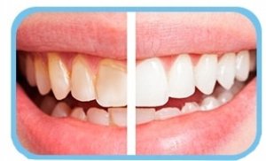 SZCZOTECZKA SONICZNA SKALER USUWA KAMIEŃ 7