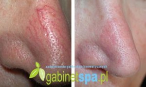 LASER Nd-Yag DO NACZYŃ NACZYNEK VESSEL 2