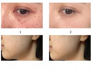 LASER PEN PLAZMA USUWANIE TATUAŻU BLIZN BRODAWEK 4