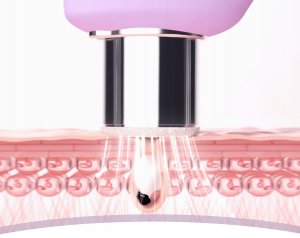 FOREO KIWI derma Urządzenie do Mikrodermabrazji Próżniowe Oczyszczanie 3