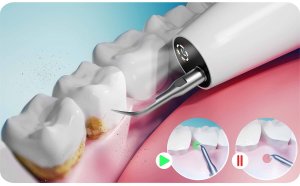 Berdsen Skaler ultradźwiękowy kamera do zębów 4 tryby do usuwania kamienia LED Berdsen BD-250 6
