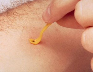 KICK THE TICK KLESZCZOŁAPKI ŁAPKI PRZYRZĄD DO WYCIĄGANIA USUWANIA KLESZCZY TICK TWISTER 2