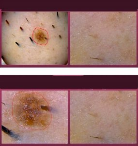 Thymuskin Detektor Skóry Głowy i Włosów 5-200X Analizator Trychologiczny Wypadanie 5