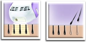 Depilator Remington i-Light Pro Face & Body IPL6000F 3