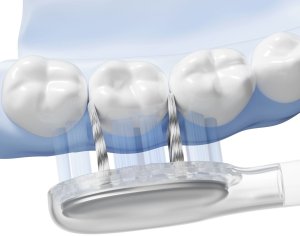 Końcówka Laifen 6 szt ProS Miękkość Średnia Końcówka do Szczoteczek Sonicznych Wave 5