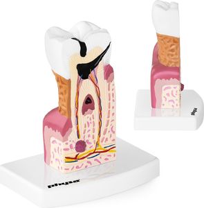 Physa Model anatomiczny chorego zęba człowieka w skali 6:1 (10040250) 1