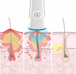 Rio Urządzenie do oczyszczenia twarzy Q-Acne Lite3 3