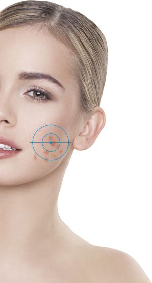 Rio Urządzenie do oczyszczenia twarzy Q-Acne Lite3 4