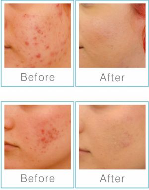 Rio Urządzenie do oczyszczenia twarzy Q-Acne Lite3 5