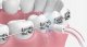 Oclean N20 Standard nozzle for A10 Transparent 3