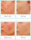 Rio Urządzenie do oczyszczenia twarzy Q-Acne Lite3 4