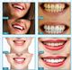 DentalForce Urządzenie do wybielania zębów LED 17